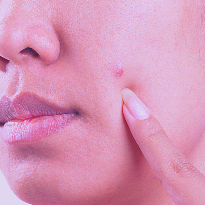 9 Ways to Heal Hormonal Acne Naturally